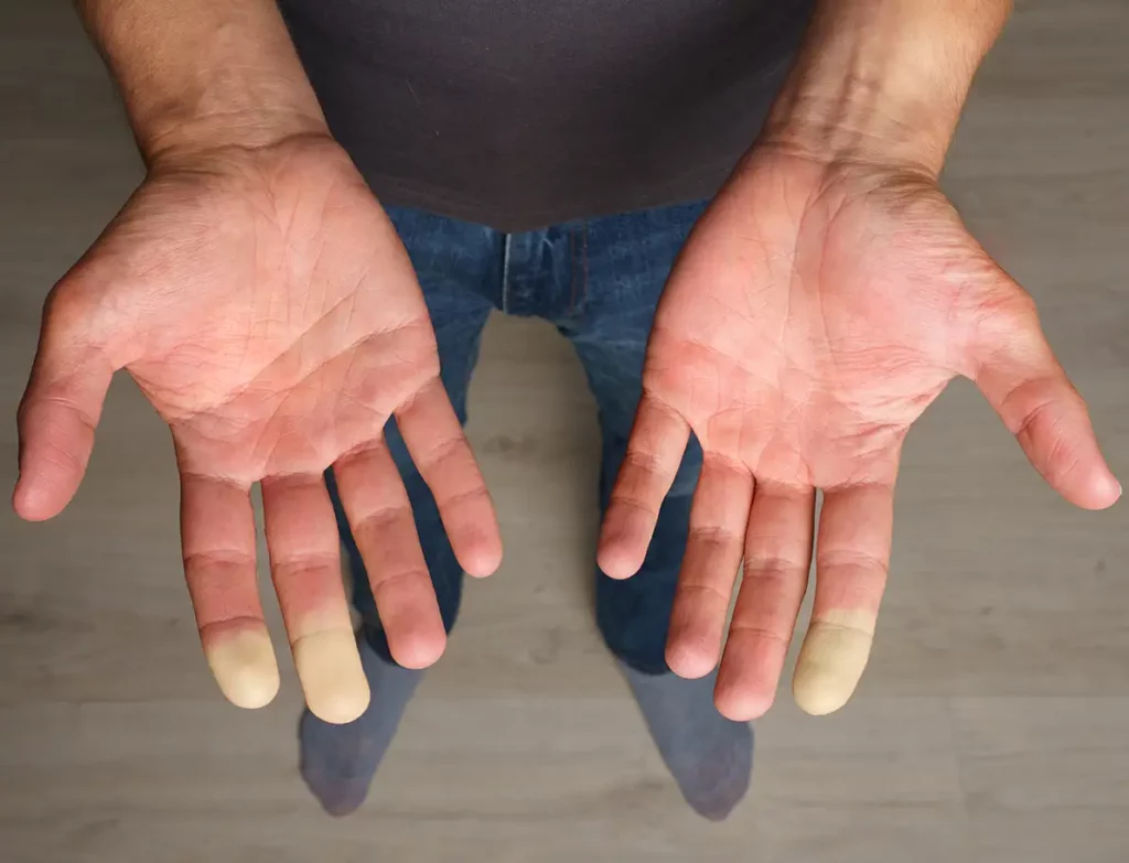 Raynaud's Phenomenon