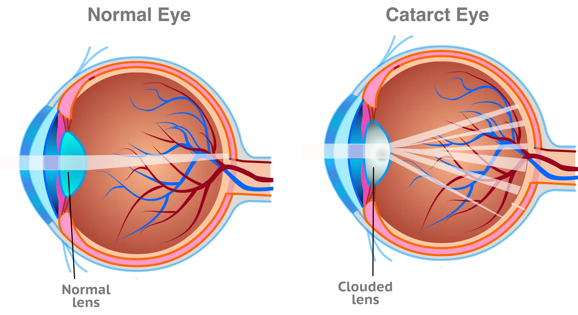 NIR Cataract Risk NIR Cataract Risk